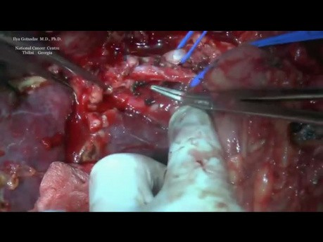 Right Hepatectomy for Multiple Colorectal Metastases 