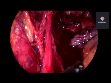 Deep Endometriosis Posterior Compartment en Bloc Resection 