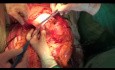 Giant abdominal sarcoma. Surgical treatment.