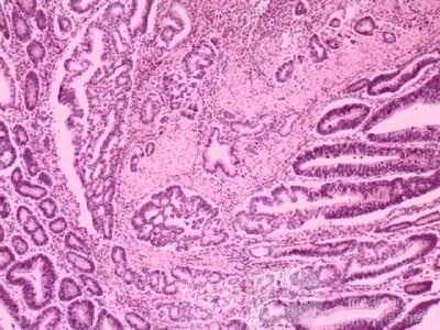 Cholangiocarcinoma that infiltrated a Periampullary Duodenal Diverticula and the head of the pancreas (17 of 20)