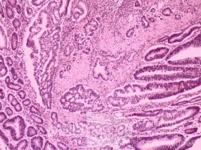 Cholangiocarcinoma that infiltrated a Periampullary Duodenal Diverticula and the head of the pancreas (17 of 20)