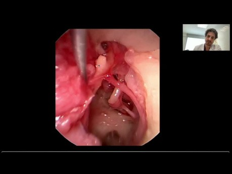 Endoscopic Anatomy of the Ear