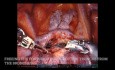 Robotic Pulmonary Right Upper Lobectomy, Unedited - EASY