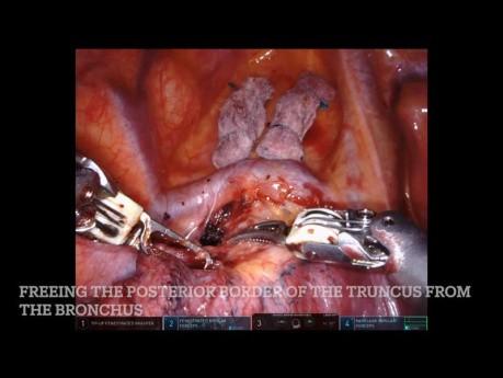 Robotic Pulmonary Right Upper Lobectomy, Unedited - EASY