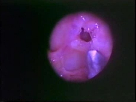 Functional Endoscopic Sinus Surgery - Anatomical Demostration - Part 5 of 5