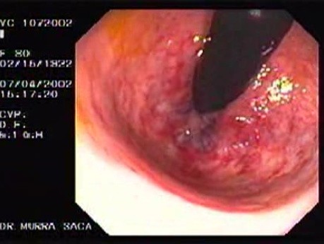 Post-Radiation Colitis (2 of 4)