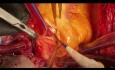 Pulmonary Valve and Aortic Valve Endocarditis and Fistula