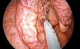 Appendectomy - transumbilical access