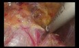 Renal‑rotation Techniques in Retroperitoneoscopic Adrenalectomy for Giant Pheochromocytomas (left-sided)