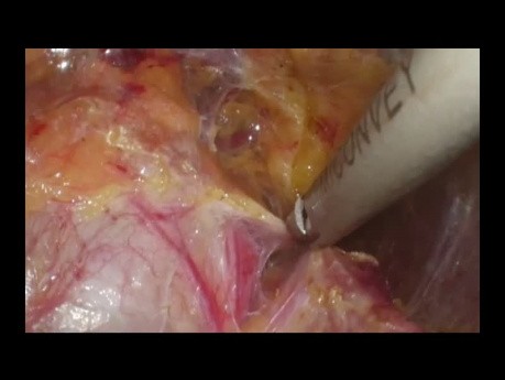 Renal‑rotation Techniques in Retroperitoneoscopic Adrenalectomy for Giant Pheochromocytomas (left-sided)