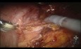 Urinary Diversion on Post-Radiotherapy Patient