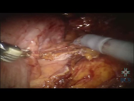 Urinary Diversion on Post-Radiotherapy Patient