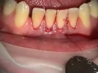 How To Cover Recession With Collagen Implant