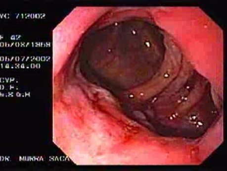 Crohn's Disease - Endoscopy (23 of 28)
