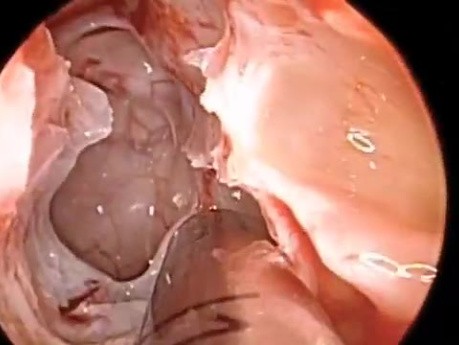 Polypectomy and Transilluminating of Sphenoid Sinus
