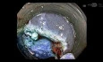 Dual-modality Approach To Active Post-polypectomy Bleeding Control