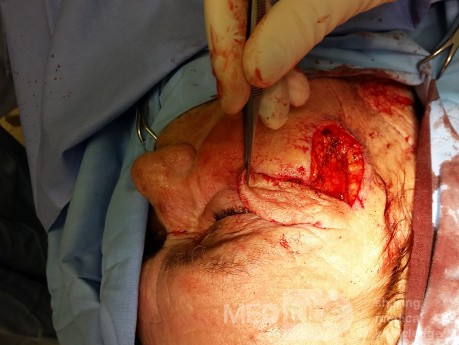 Basal Cell Carcinoma (3)