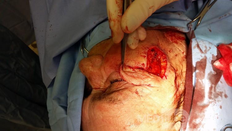 Basal Cell Carcinoma (3)