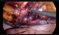 Laparoscopic TAPP for Incarcerated Groin Hernia