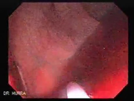 Endoscopic Resection of Giant Tubulo-Villous of the rectum (15 of 35)