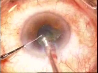 Phacoemulsification - Ozil IP - Post Uvetic Cataract