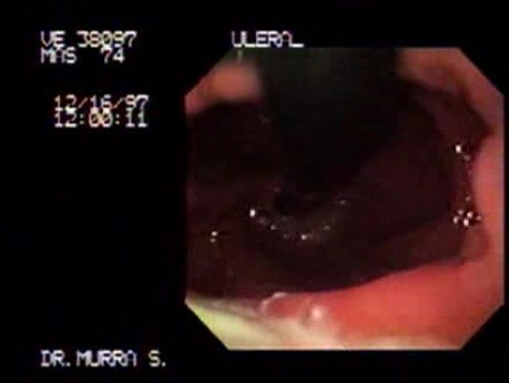 Ulcer of the Gastric Corpus (1 of 2)