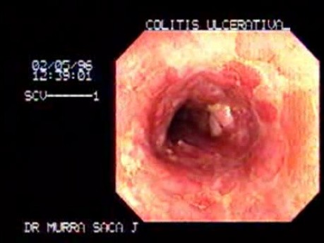 Ulcerative Colitis