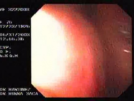 Upper Gastrointestinal Bleeding (12 of 15)