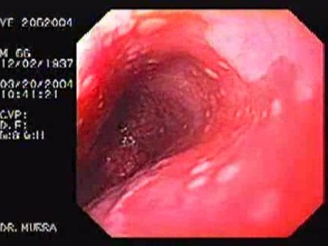 Barrett's Esophagus of long segment residual islands of squamous epithelium (2 of 24)