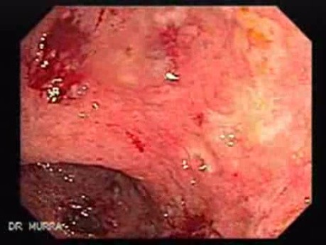 Multiple Rectal Ulcers (8 of 110)