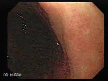 Gastrointestinal Stromal Tumor - GIST (6 of 13)