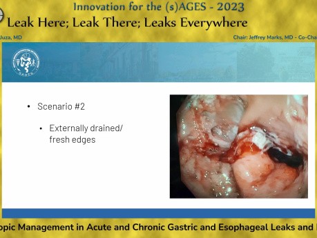 Endoscopic Management in Acute and Chronic Gastric and Esophageal Leaks and Fistulas