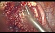 Big Severe Adenoma Disturbing Cavity in Unmarried Patient, Laproscopic Adenoma Excision Done