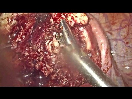 Big Severe Adenoma Disturbing Cavity in Unmarried Patient, Laproscopic Adenoma Excision Done