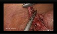 Laparoscopic Management of Stump Appendicitis