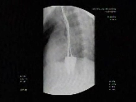 Esophageal Achalasia (5 of 10)