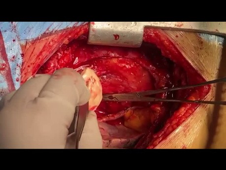 Patient with SVCS and Bacterial Endocarditis and Endophelbitis Undergone SVC Resection and Restoration with Homograft