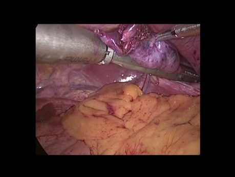 Laparoscopic Diaphragmatic Plication