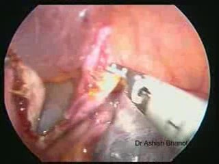 Laparoscopic Ovarian Cystectomy