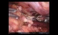 Mediastinal Tumor