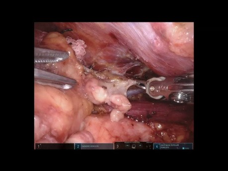 Mediastinal Tumor
