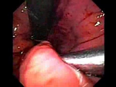 Retrograde Gastroplicature - Suturing - 1/3