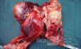 Small bowel obstruction due to Non Hodgkin's lymphoma 1