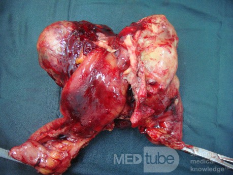 Small bowel obstruction due to Non Hodgkin's lymphoma 1