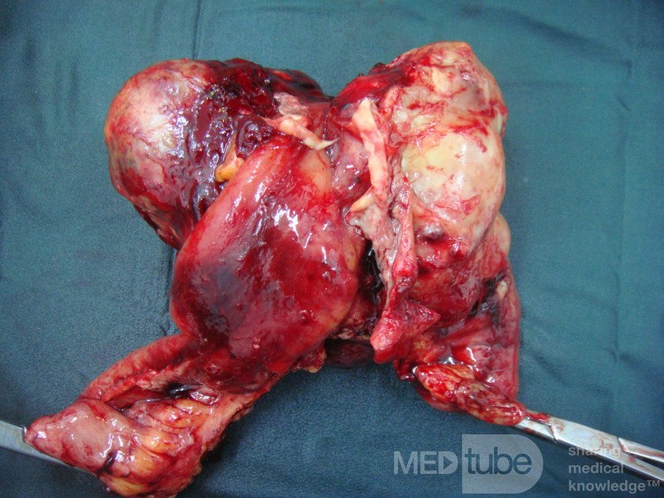 Small bowel obstruction due to Non Hodgkin's lymphoma 1
