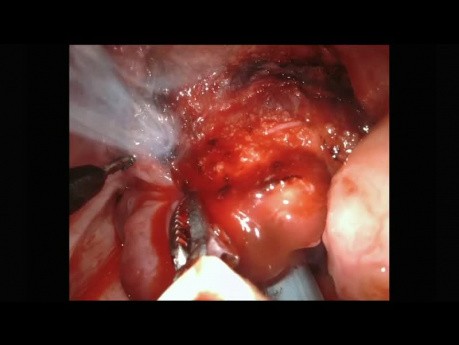 Transoral Robotic Surgery (TORS) Excision of a Base of Tongue Venolymphatic Malformation in a Pediatric Patient