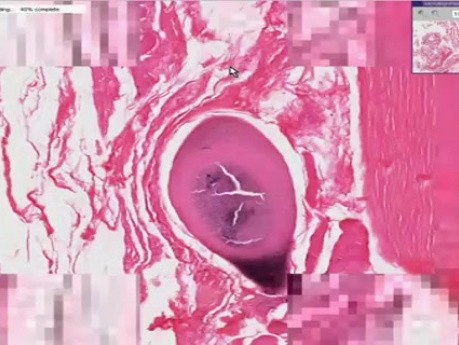 Trichinosis