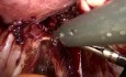 Ureteric Dissection