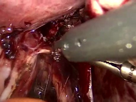 Ureteric Dissection
