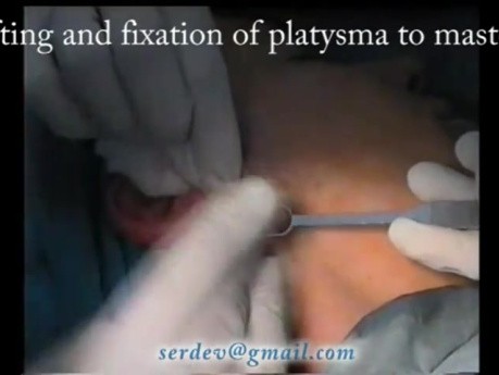 Face lift with retrolobular incision